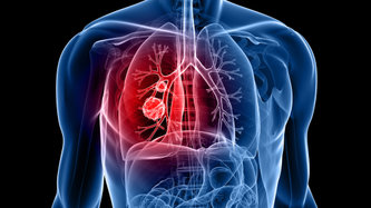 Akciğer kanserinde yeni tedaviler