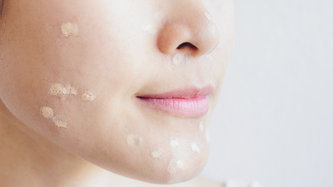 Akne (Sivilce) Nedir? Akne Belirtileri, Nedenleri ve Tedavisi