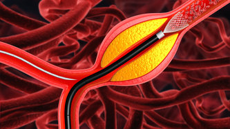 Anjiyo Ameliyatı Nedir?