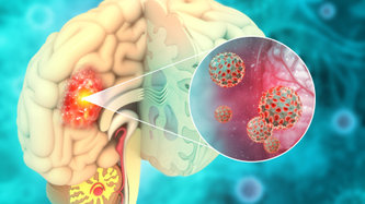 Beyin Tümörü Nedir?