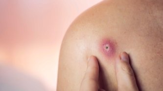 Çıban Nedir? Çıban Neden Çıkar?