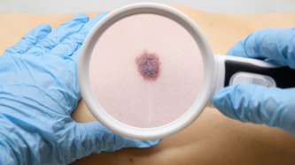 Deri Kanseri Türleri, Tanı ve Tedavi Süreçleri