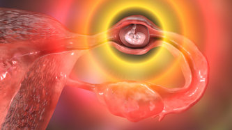 Dış Gebelik Nedir? Dış Gebelik Belirtileri Nelerdir?