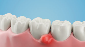 Diş Kisti Nedir? Belirtileri ve Tedavisi