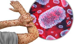 Fabry Hastalığı Nedir? Belirtisi ve Tedavisi