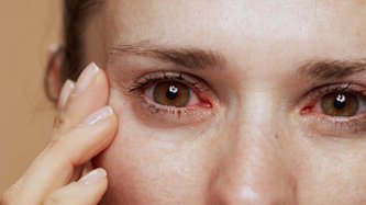 Göz Batması Neden Olur? Göz Batması Nasıl Geçer?