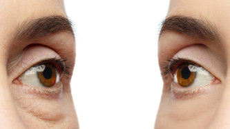 Göz Kapağı Sarkması Tedavi Edilebilir