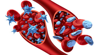 Hiperkalsemi Nedir? Hiperkalsemi Belirtileri Nelerdir?