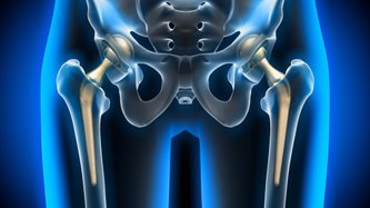 Kalça Protezi: Nedir, Ameliyatı, Ameliyat Sonrası Yaşam