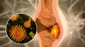 Kemik Kanseri Nedir? Kemik Kanseri Belirtileri Nelerdir?