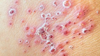 Pemfigus Nedir? Pemfigus Neden Olur?