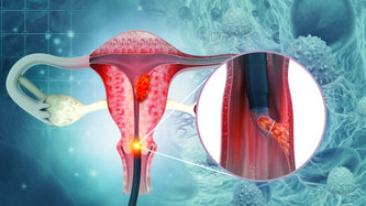 Rahim Ağzı Kanseri: Belirtileri, Teşhis & Tedavi Yöntemleri