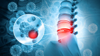 Tarlov Kistleri Nedir? Belirtileri ve Tedavisi