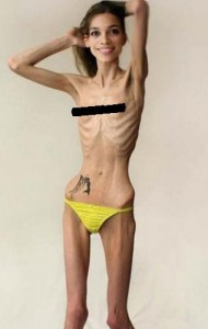 Anoreksia Mervosa