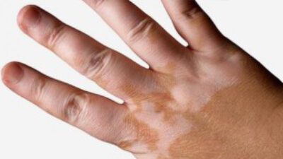Vitiligo Hastalığı Nasıl Tedavi Edilir?